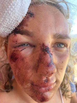 Read more about the article Tourist Severely Injured in Quad Bike Accident in Greece Issues Warning to Others