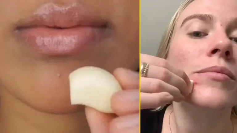 Viral TikTok Garlic Acne Hack Sparks Warnings from Skincare Experts